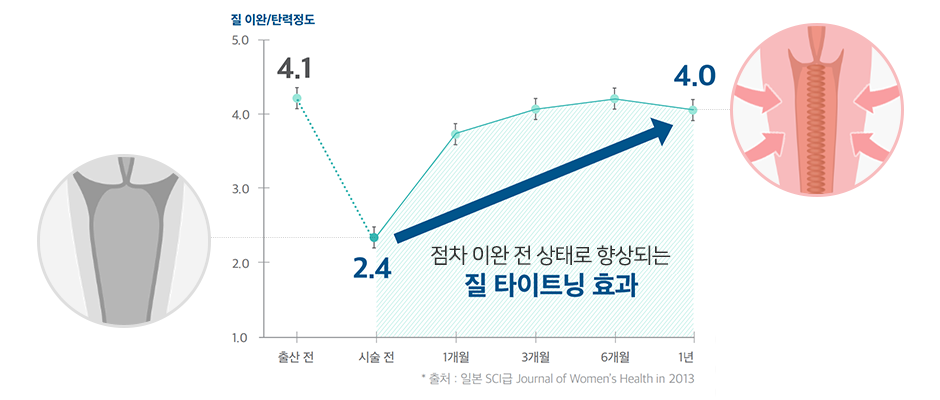 비비브 팁 사진